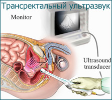 ultrasound Transrectal