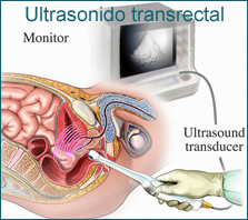 ultrasound Transrectal